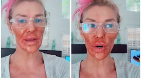 Orrore in diretta: Modella sfigurata da una crema depilatoria! Il video shock che ha scioccato il web