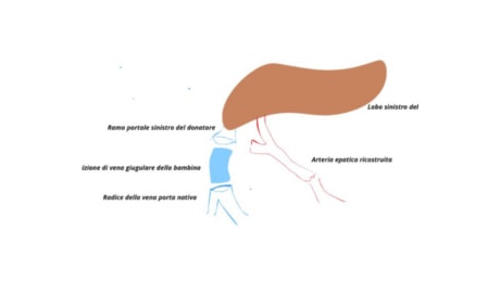 Salvata bimba di 7 mesi con trapianto di una parte di fegato pediatrico ed autotrapianto di vena porta, presso l'ospedale Molinette di Torino